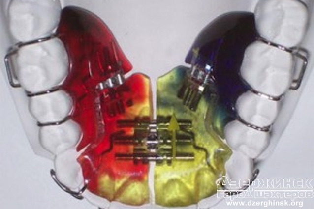 http://www.dentalfantasy.ru/services/orthodontics/plastinki-dlya-zubov/